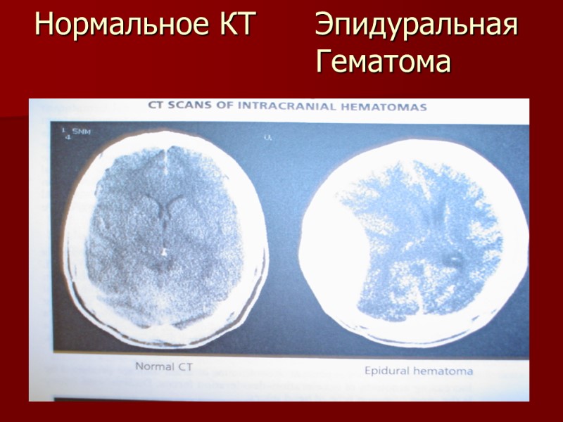 Нормальное КТ  Эпидуральная      Гематома